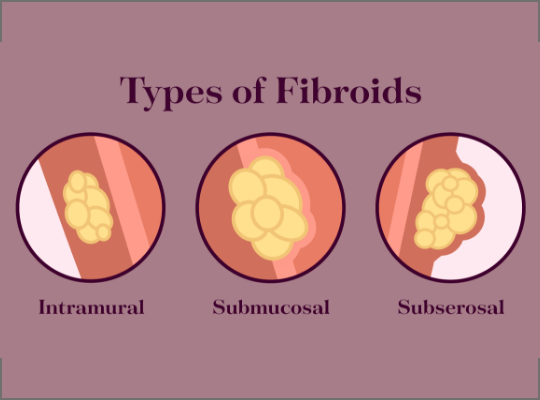 video-do-fibroids-effect-fertility