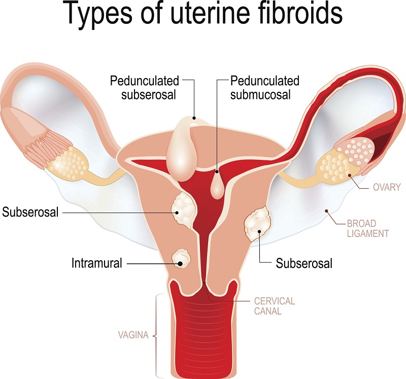do-fibroids-affect-fertility-2