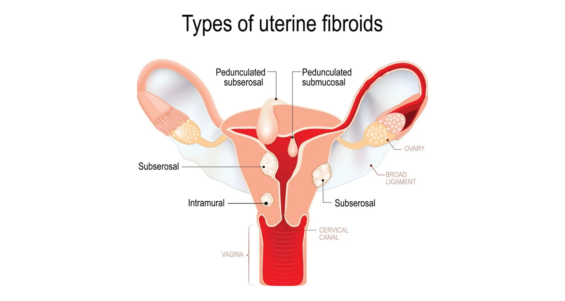 types-uterine-fibroids