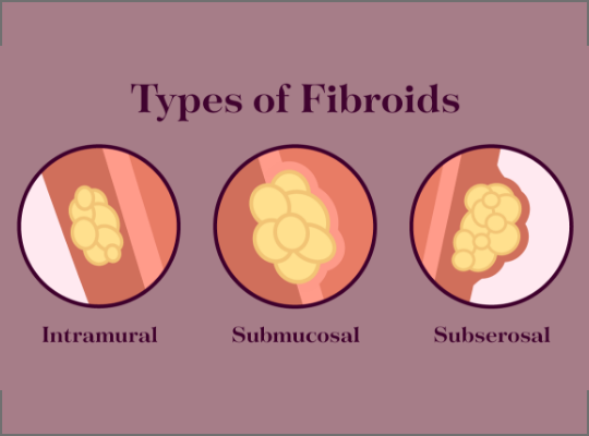 Do Fibroids Affect Fertility